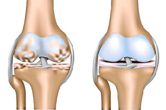 Articulation et arthrose saines