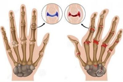 Les causes de la douleur dans les articulations des doigts