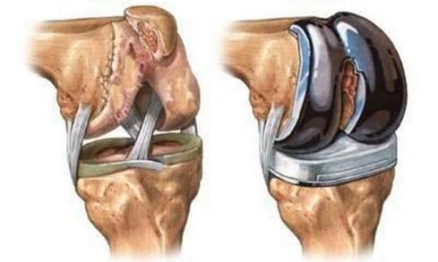 Endoprosthétique de l'articulation du genou pour l'arthrose