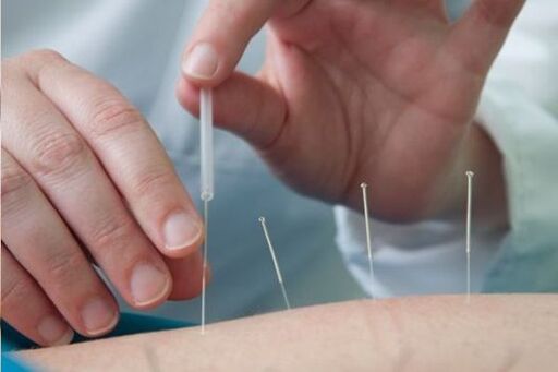 L'acupuncture est une méthode de traitement de la douleur dans la région lombaire causée par l'ostéochondrose