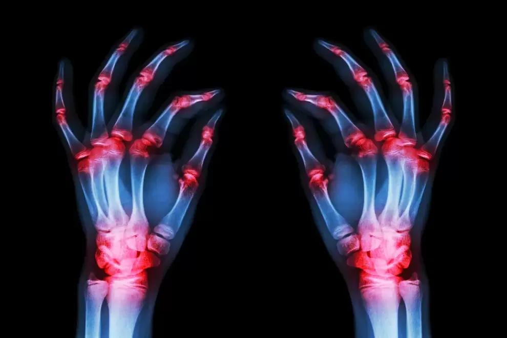 arthrose des articulations des doigts