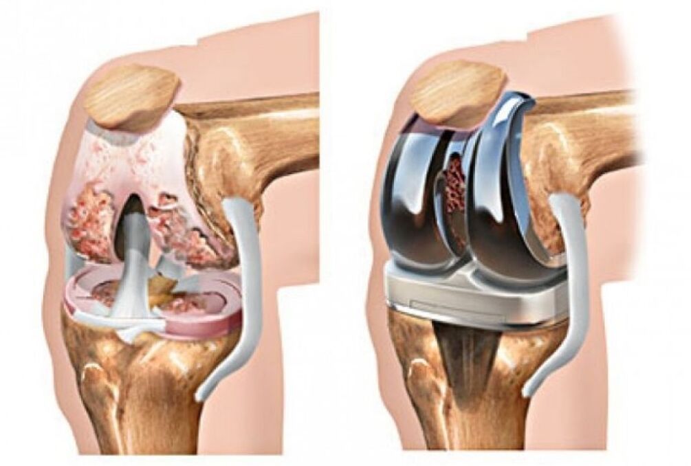 arthroplastie du genou pour arthrose