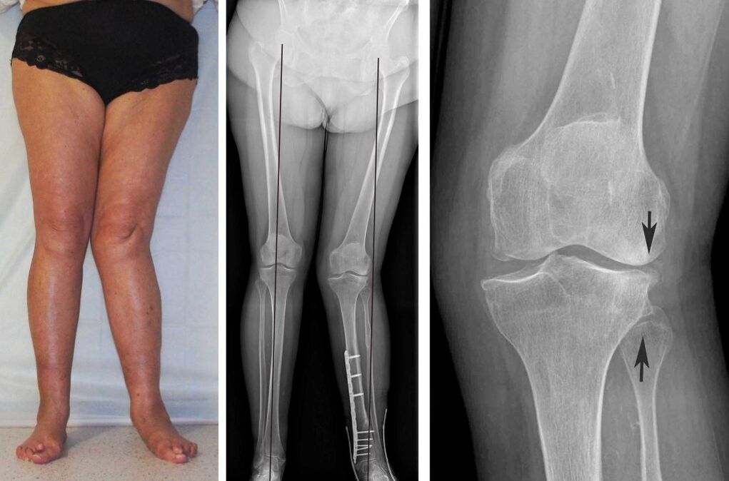 tableau clinique de l'arthrose du genou