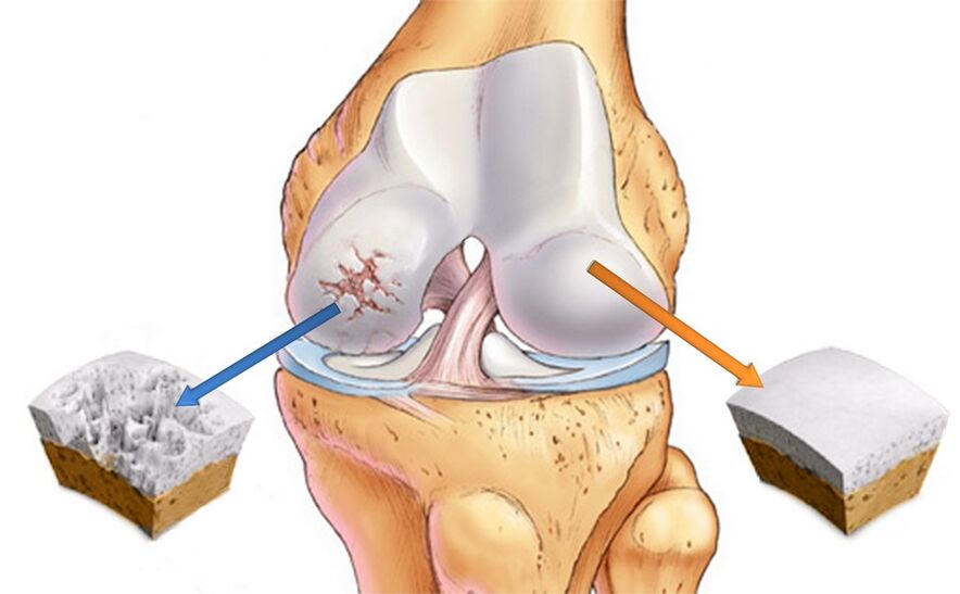 Articulation du genou saine (droite) et atteinte d'arthrose (gauche)